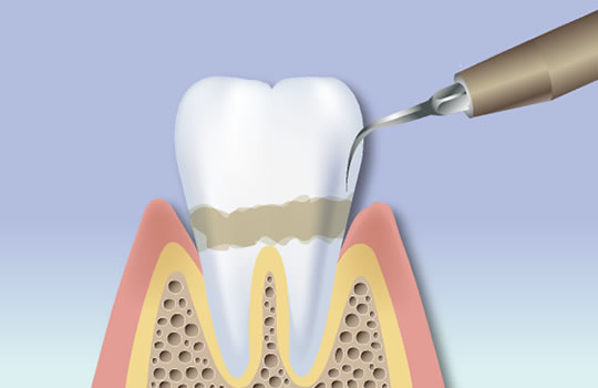 歯石取り