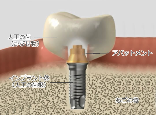 インプラントの仕組み